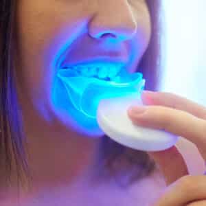 Kit de blanchiment des dents laval et montreal