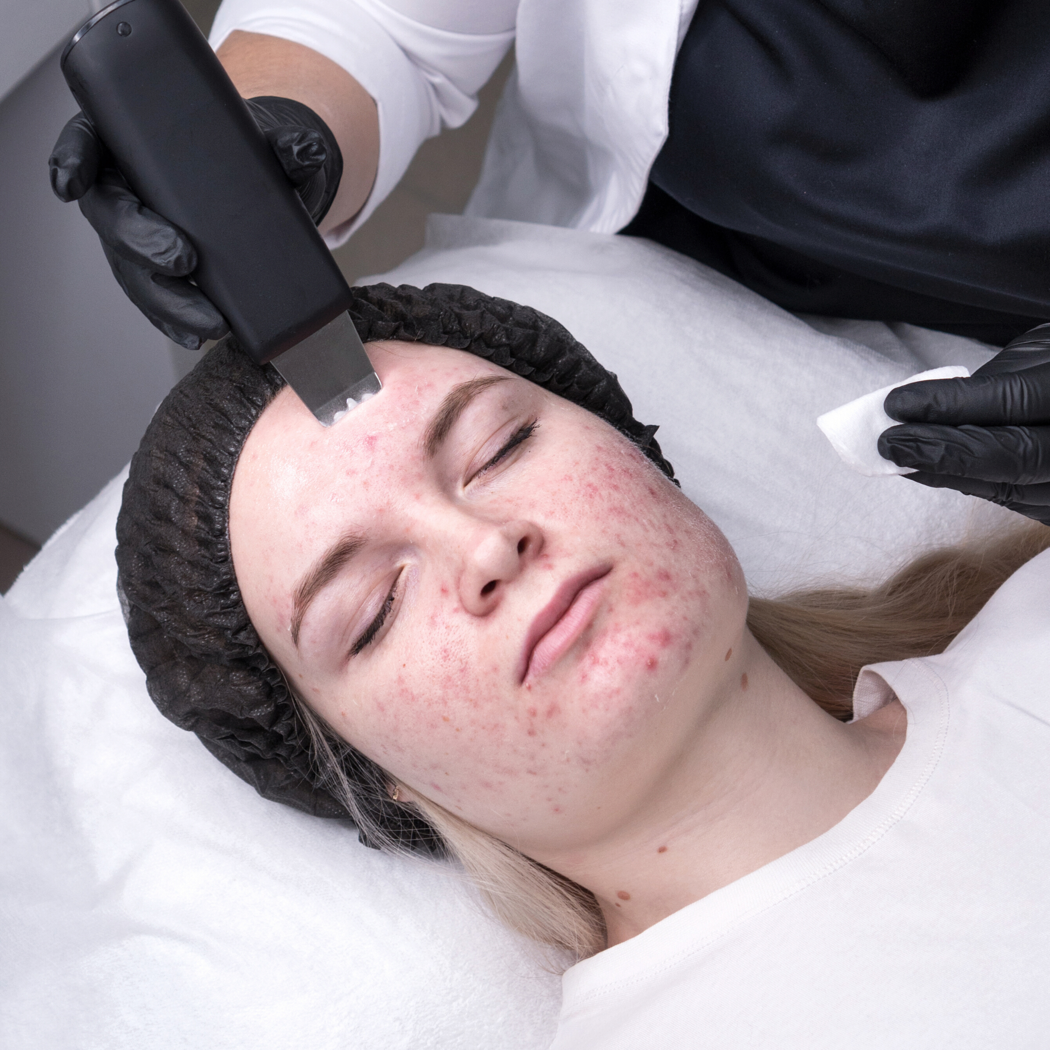 Extractions faciales à Laval | Meilleur traitement de spa médical | Clinique Reimagine