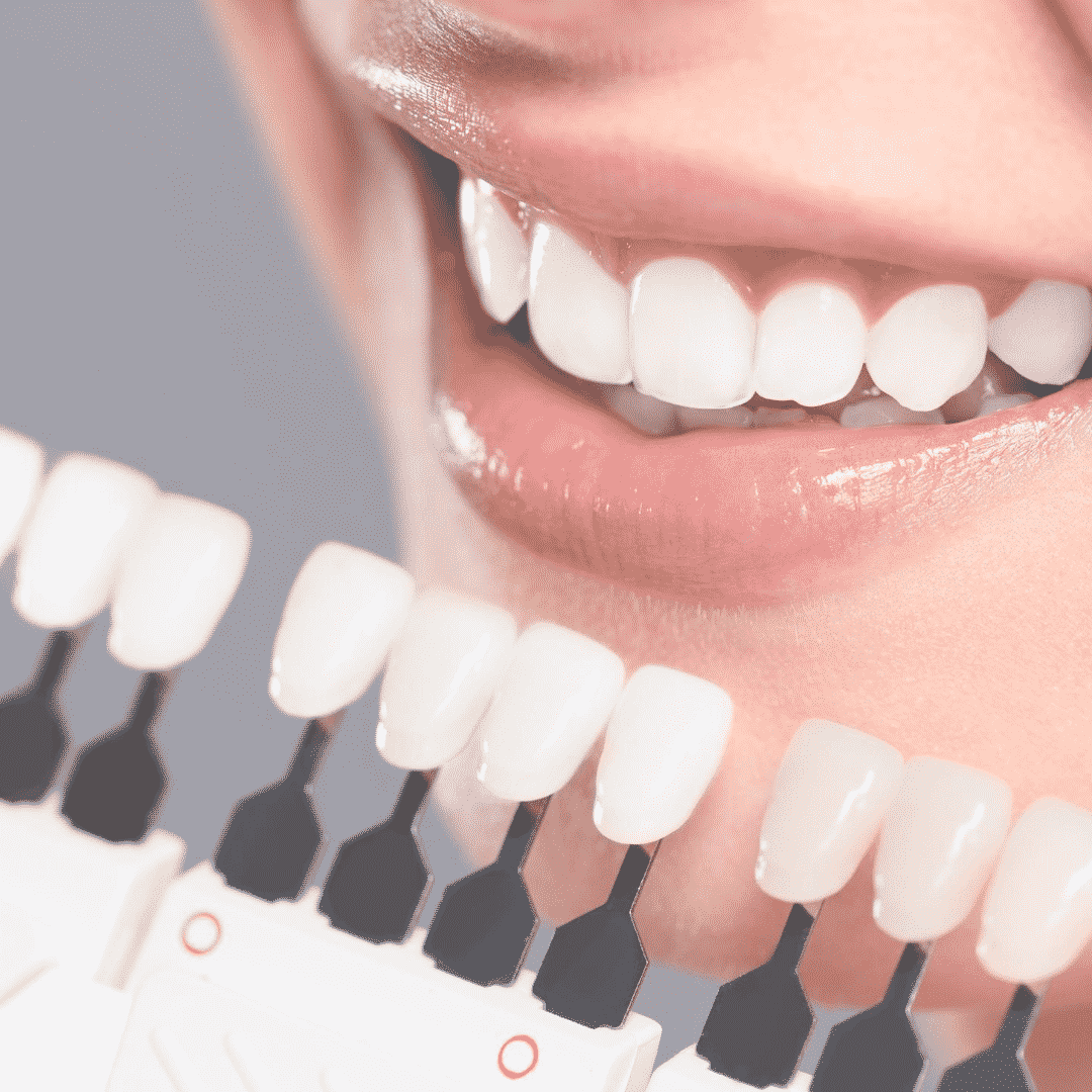 Professional Teeth Whitening Services