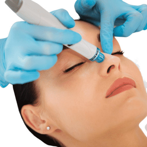 hydrafacial blackheads extraction montreal quebec