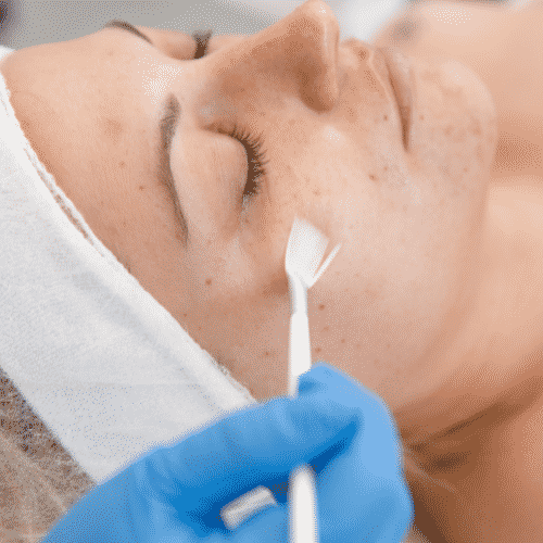chemical peel for blackhead extractions in montreal quebec