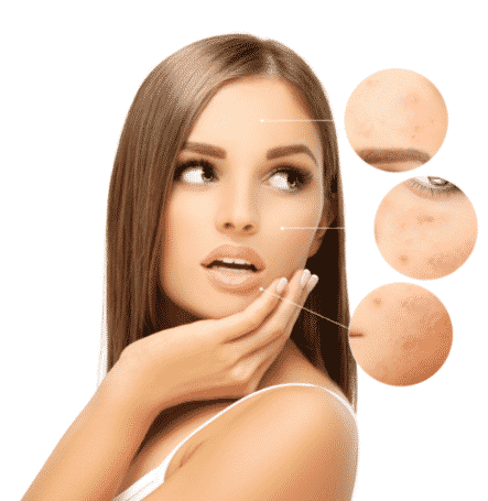 acne skin solution montreal quebec