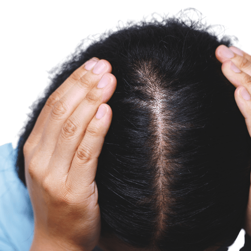 SMP hair loss montreal canada