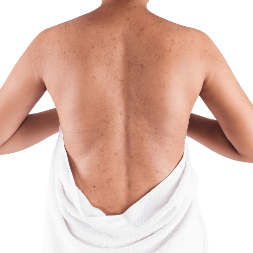solutions pour l'acné du dos offertes à montréal par la clinique reimagine