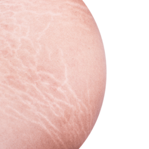 stretch mark solution offered in montreal by reimagineclinic