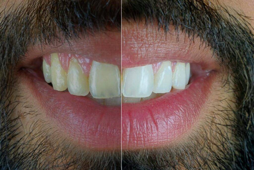 teeth whitening before and after results montreal quebec