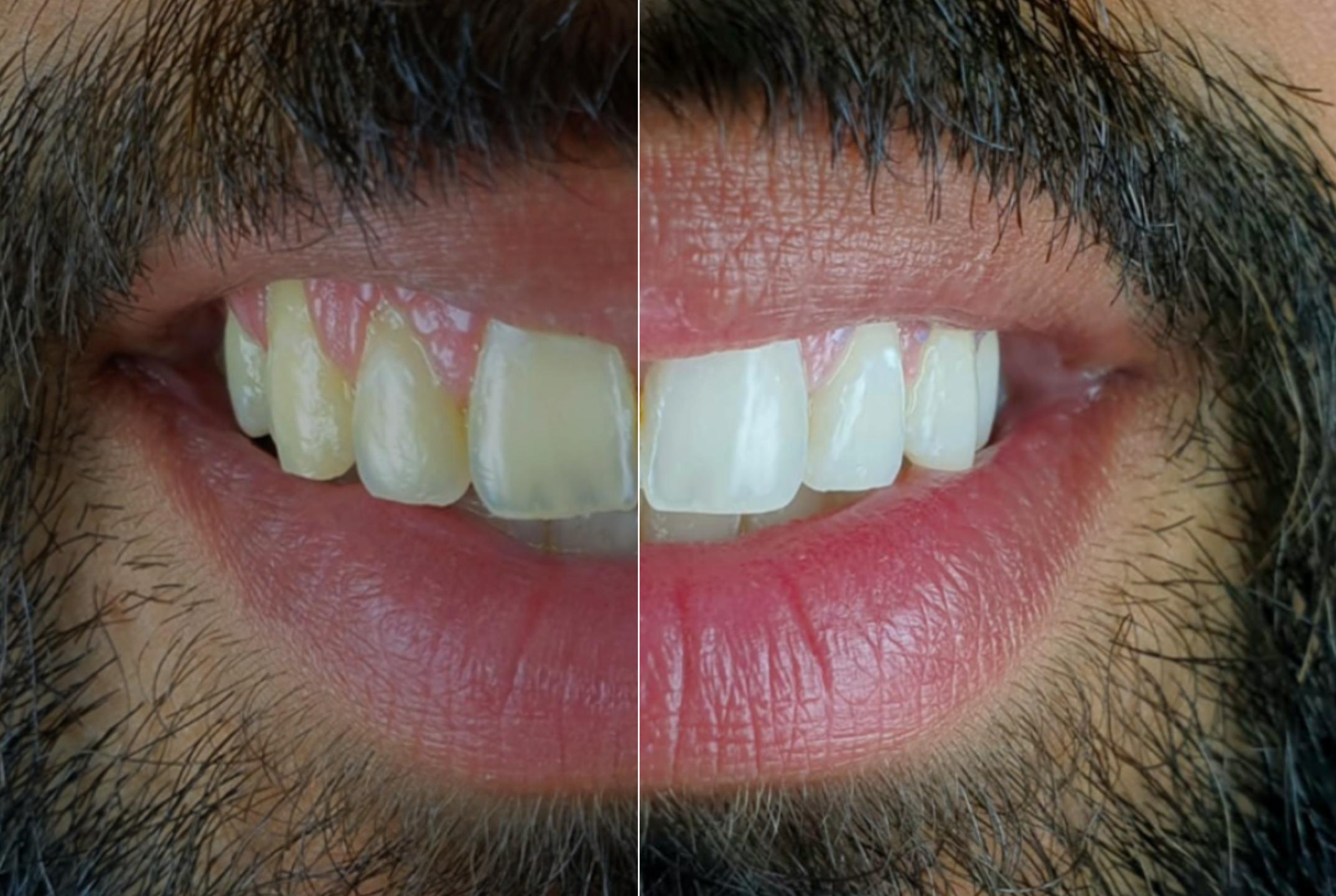 blanchiment des dents avant et après résultats montreal quebec