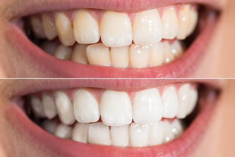 blanchiment des dents avant et après résultats montreal quebec