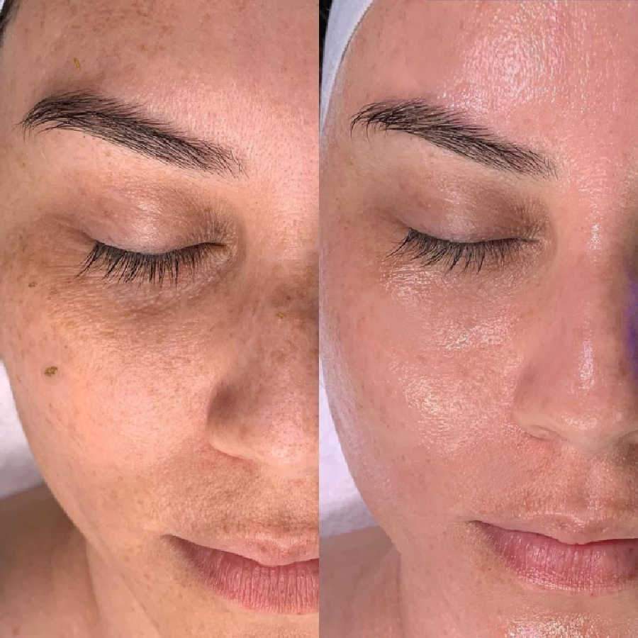 hydra dermabrasion results training montreal quebec