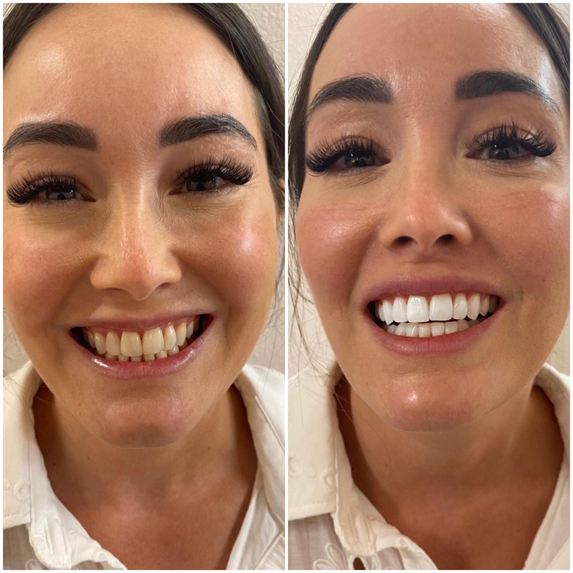 teeth whitening before and after results montreal quebec