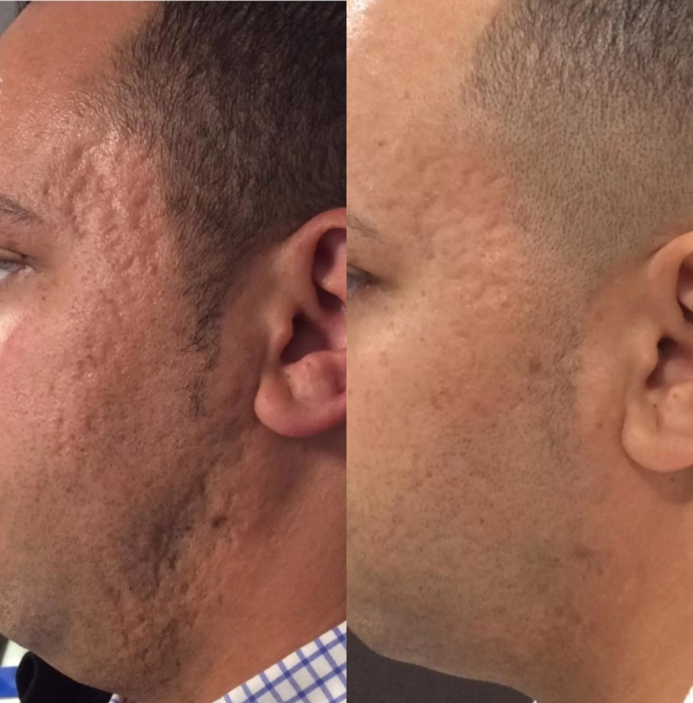 microneedling training results montreal quebec