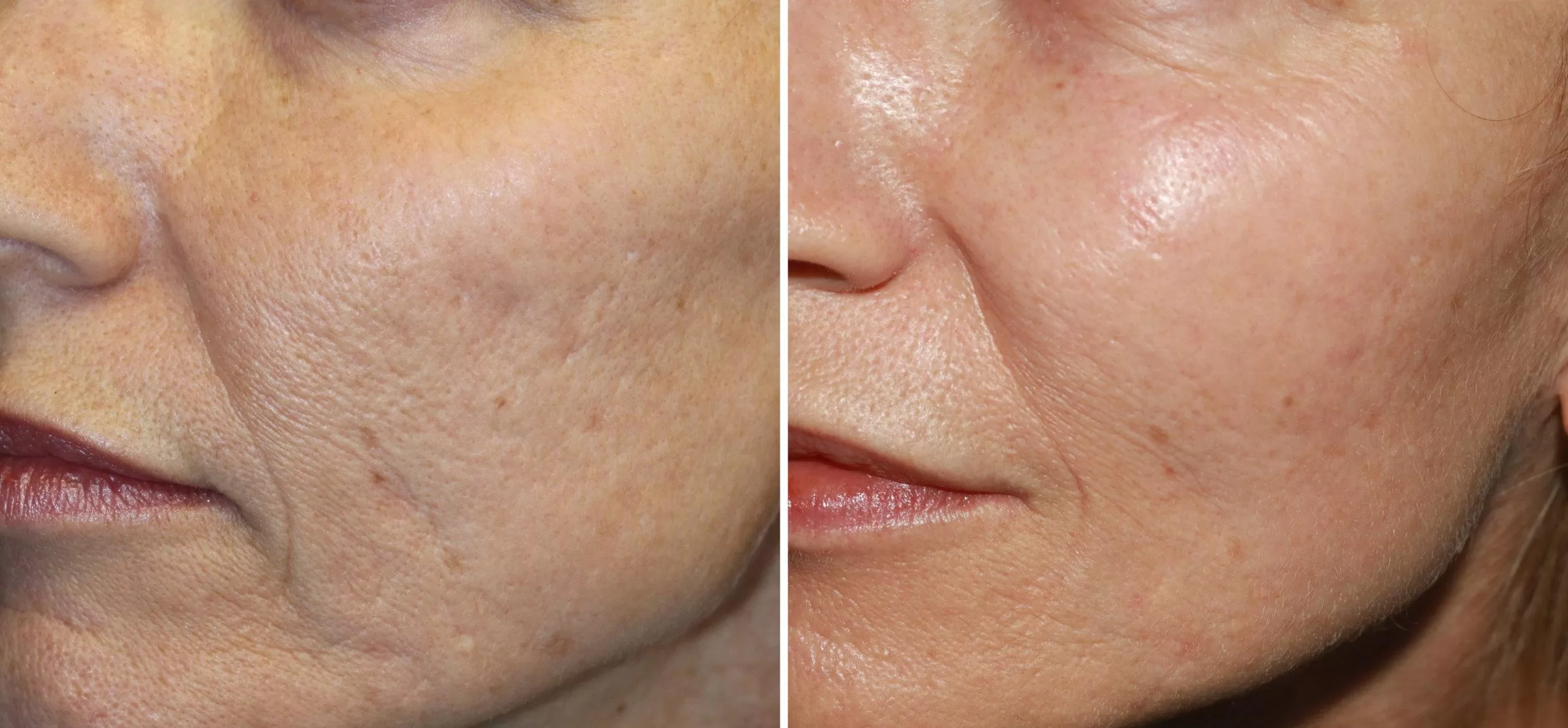 microneedling training results montreal quebec