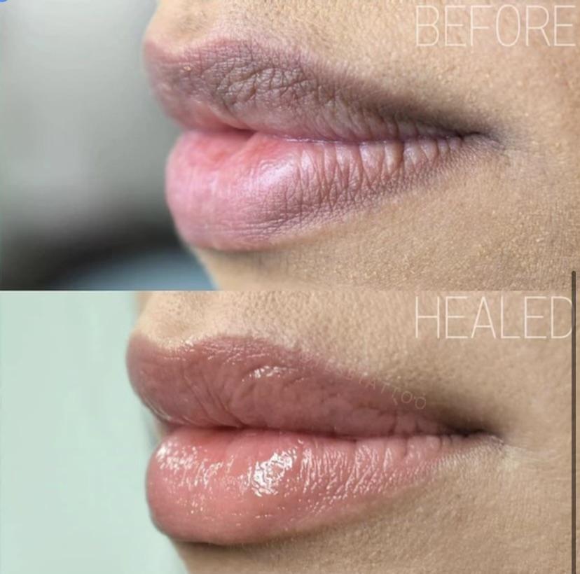 dark lips neutralization treatment montreal