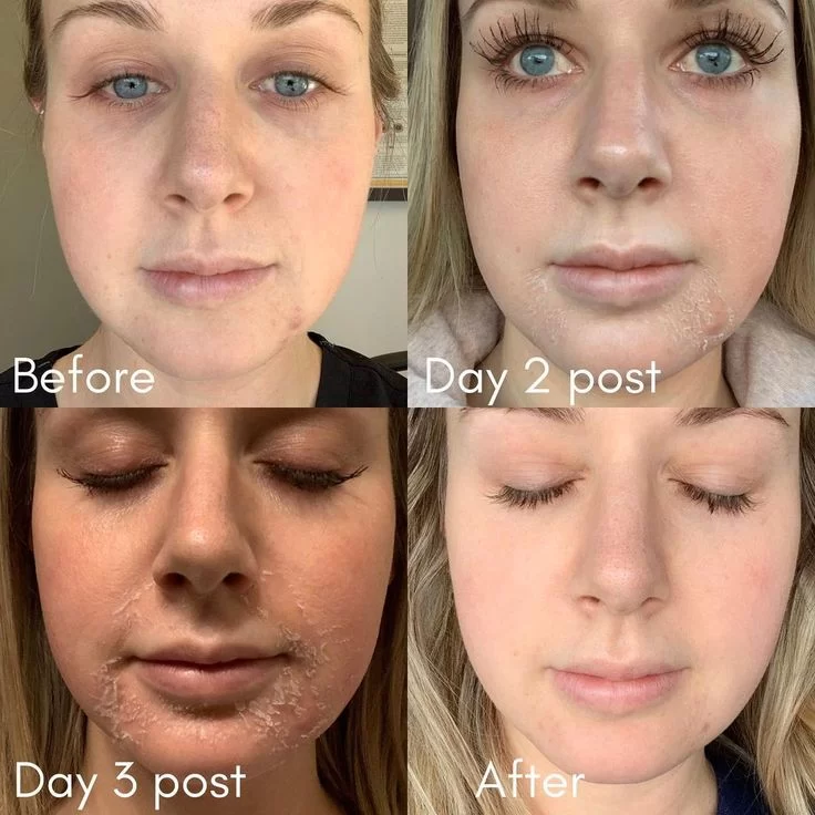 chemical peel treatments before and after in montreal