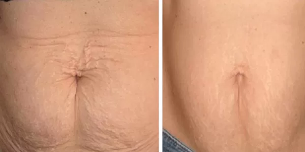 stretch mark microneedling montreal