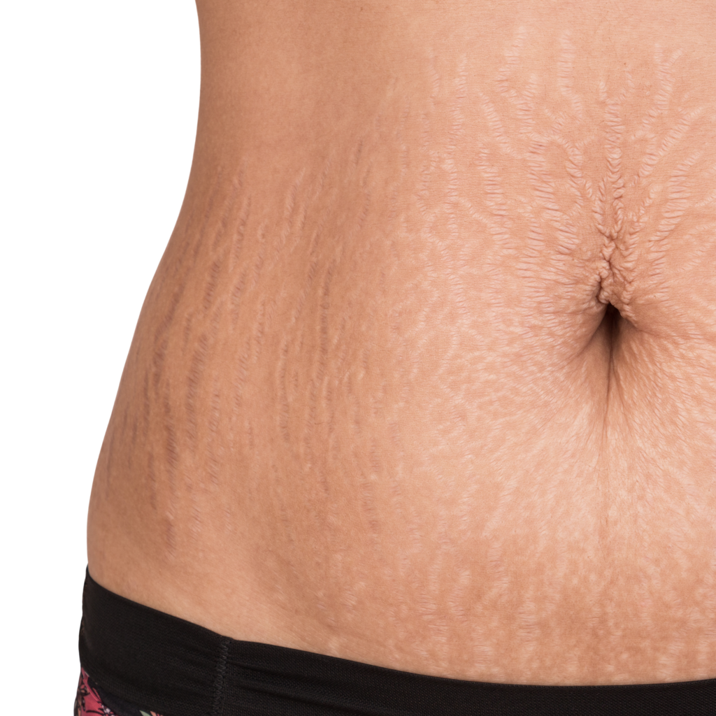 stretch mark microneedling montreal