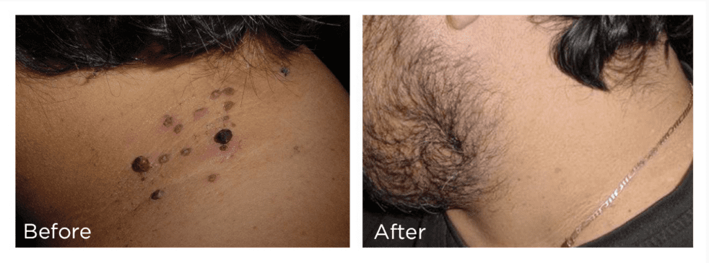 mole removal treatment montreal