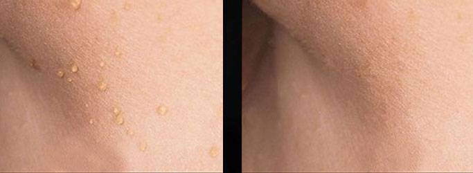 skin tag removal montreal
