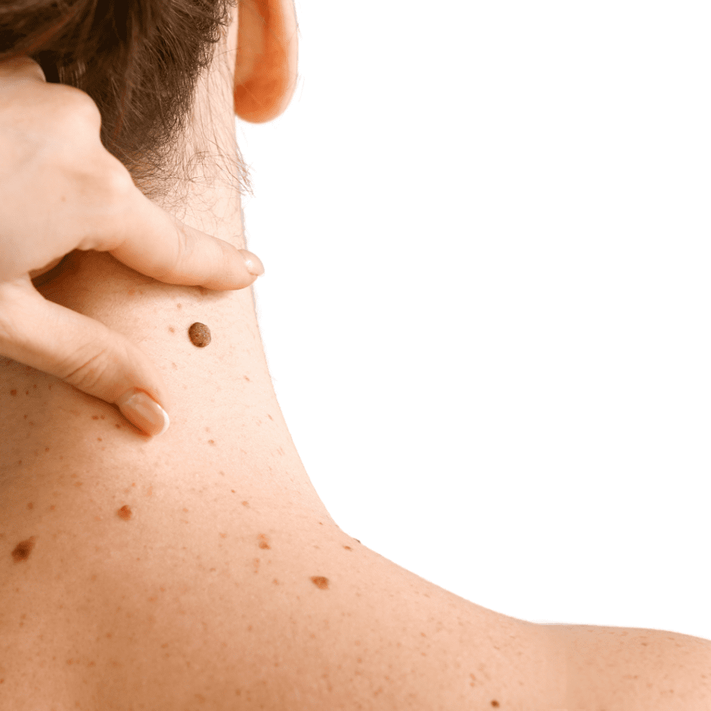 Mole Removal Treatments Montreal