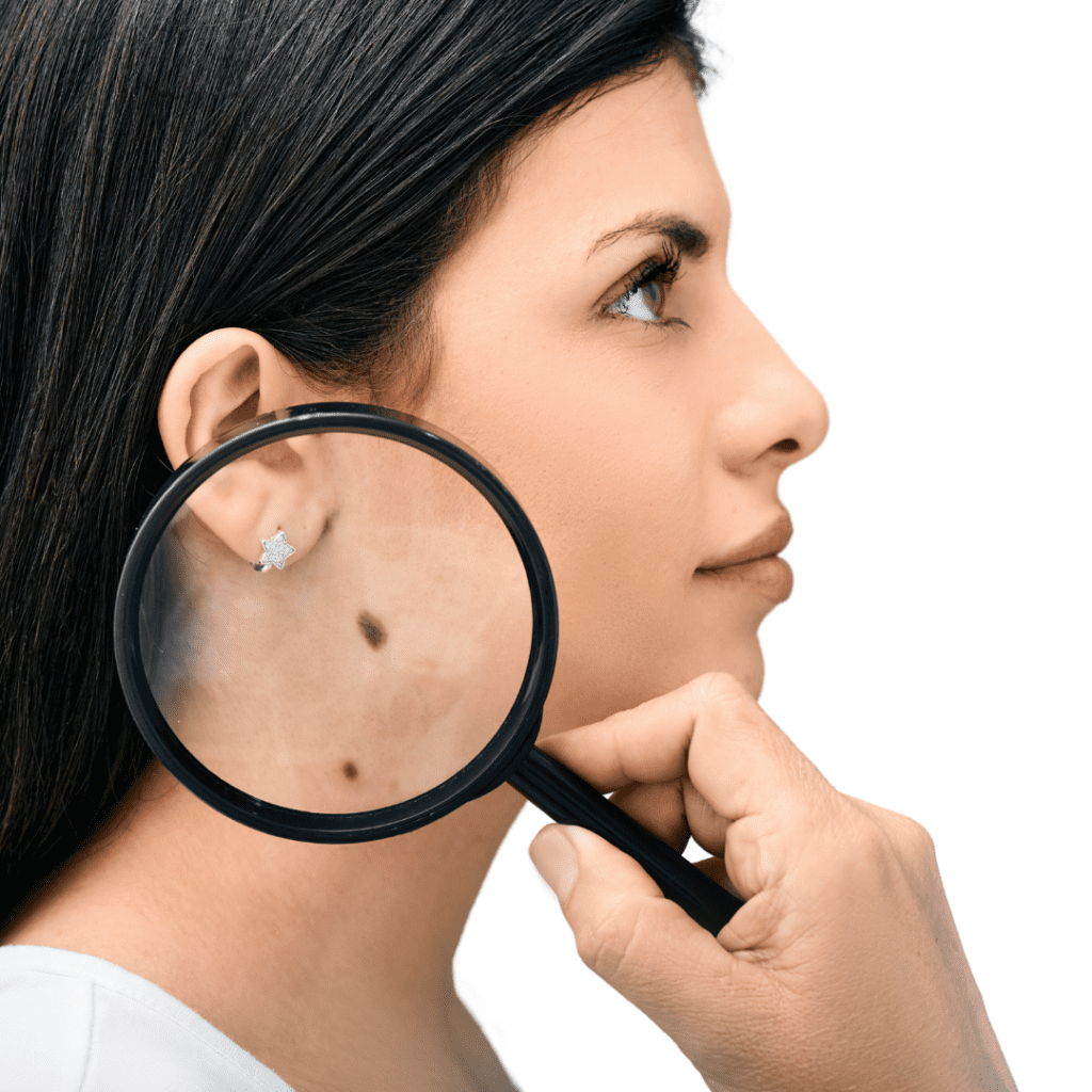 mole removal treatment montreal