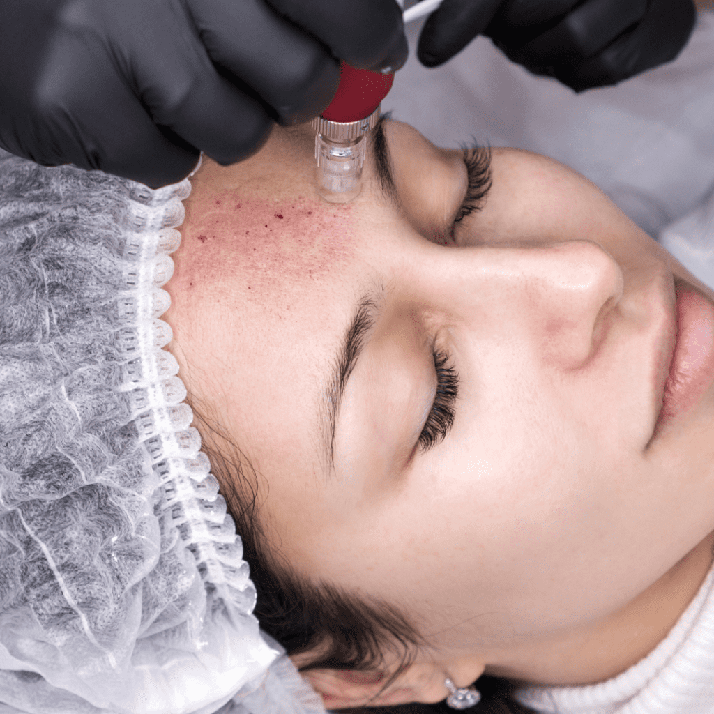 microneedling facial laval