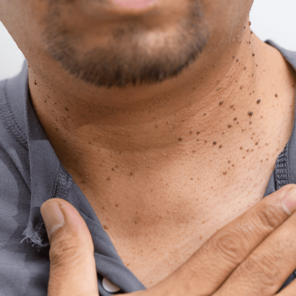 skin tag removal montreal