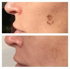 age spot removal montreal
