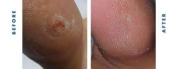wart removal montreal