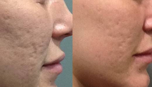collagen induction therapy