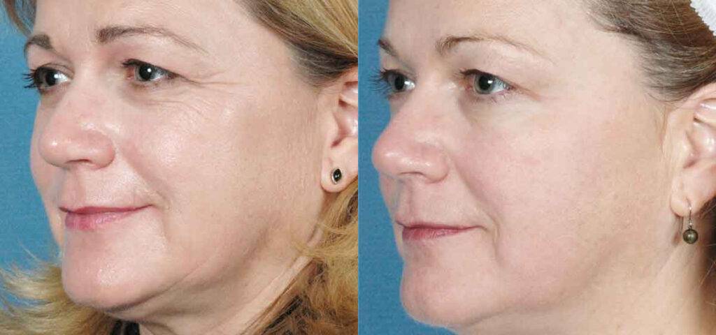 laser skin resurfacing results montreal