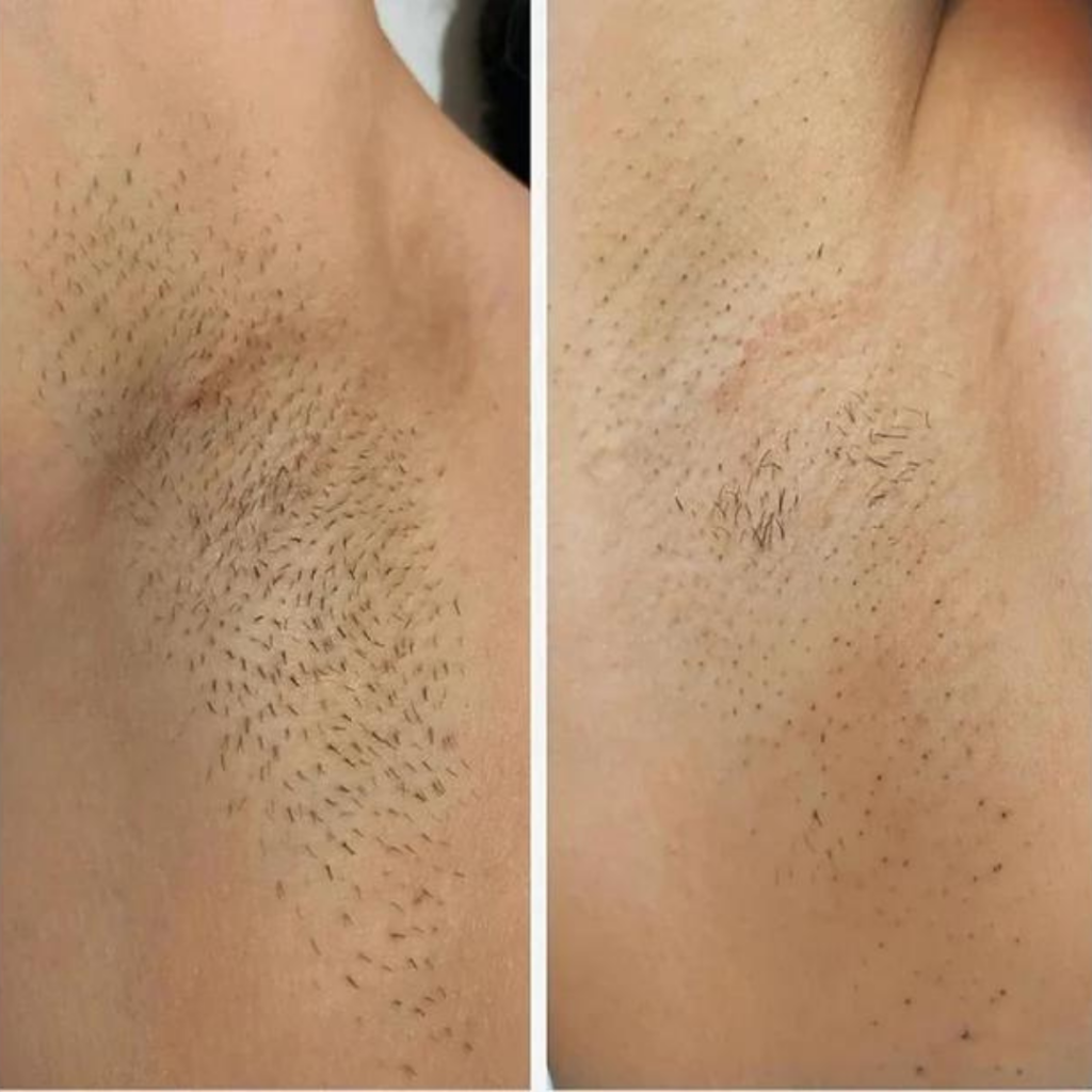 laser hair removal montreal