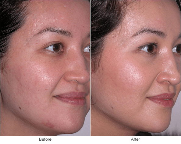 microdermabrasion treatment montreal
