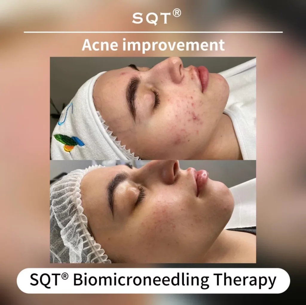 sqt bio microneedling pour l'acné