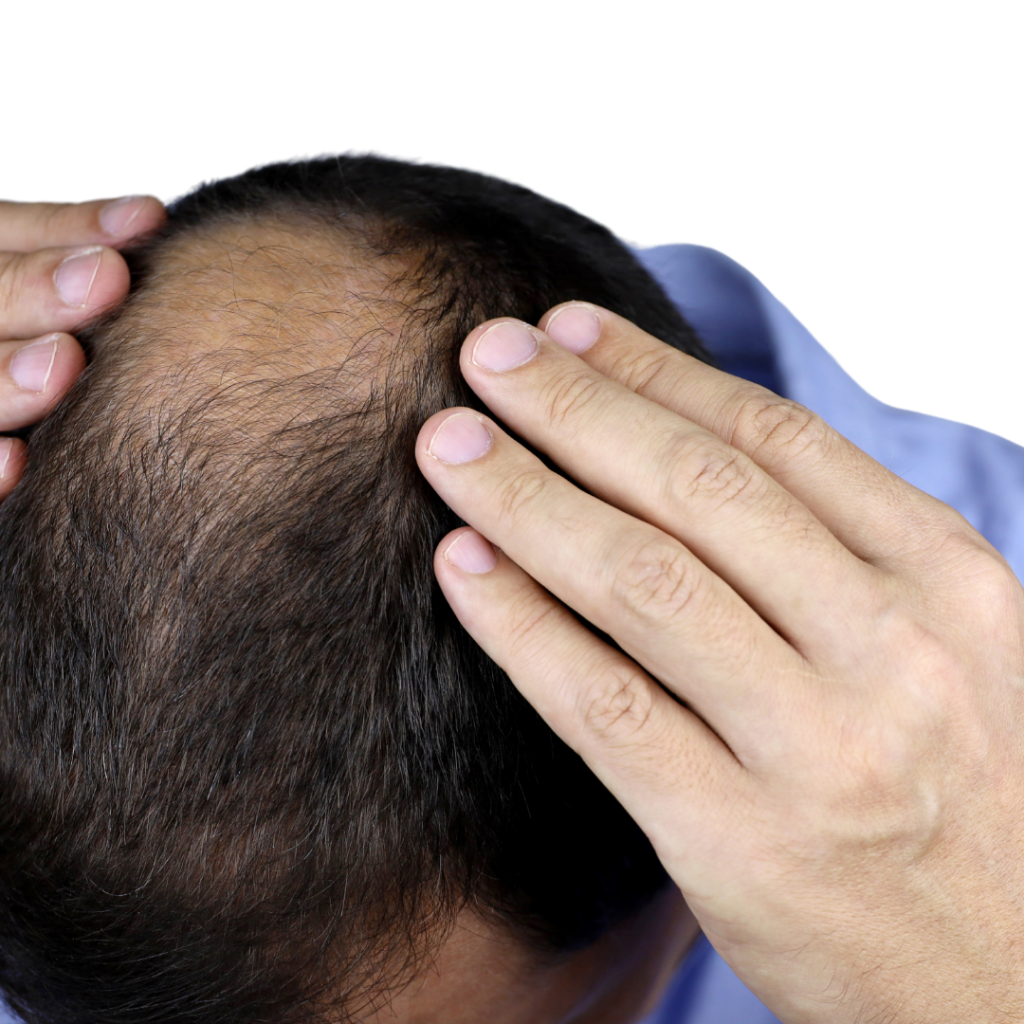 traitement pour la perte de cheveux montreal